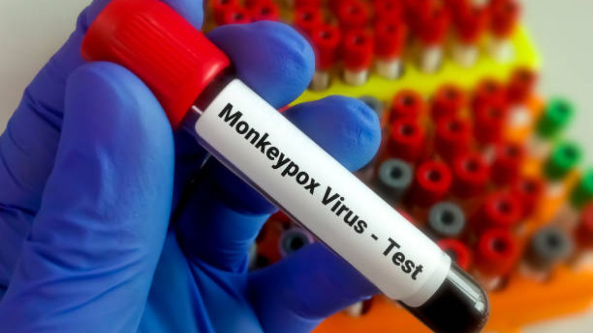 People living with HIV/AIDS are at higher risk of contracting monkeypox - NACA issues advisory